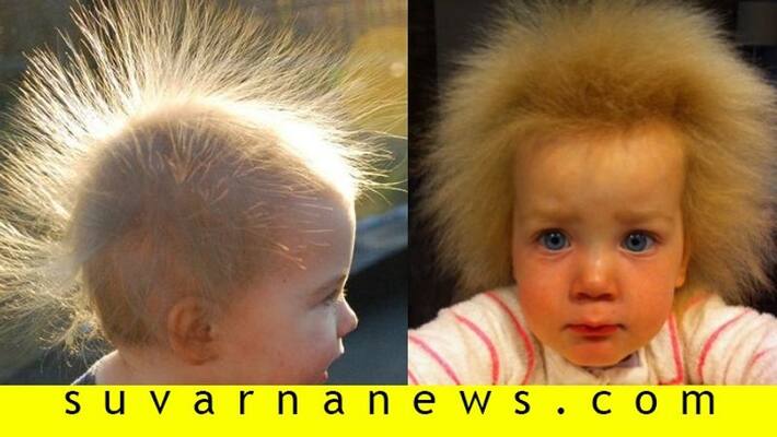what causes Uncombable Hair Syndrome Is Real what causes Uncombable Hair Syndrome Is Real
