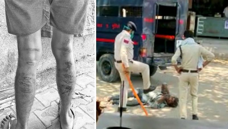 पहली तस्वीर सूरत के अलथाण की है। 27 वर्षीय पीड़ित तेज बहादुर यादव भटार रोड पर संकल्प शॉपिंग सेंटर में सिक्योरिटी गार्ड है। मूलत: यूपी के कानपुर का रहने वाला तेज बहादुर शनिवार की शाम 6.30 बजे शॉपिंग सेंटर के गेट के अंदर अपने परिजनों से वीडियो कॉल पर बात कर रहा था। इसी बीच वहां दो पुलिसवाले पहुंचे। उन्होंने लॉकडाउन के बहाने सिक्यारिटी गार्ड के पैर में जमकर डंडे मारे। उनका कहना था कि लॉकडाउन में शॉपिंग सेंटर क्यों खोला? जबकि सिक्योरिटी गार्ड का कहना था कि वो यही रहता है, इसलिए बाहर गेट पर खड़ा था। इस मामले में कांस्टेबल रंजीत और बलवंत को सस्पेंड कर दिया गया है।
दूसरी तस्वीर मध्य प्रदेश के छिंदवाड़ा की है। कुछ दिन पहले 30 वर्षीय युवक को दो पुलिसवालों ने बेरहमी से पीटा था। इसका वीडियो वायरल हुआ था। युवक शराब पीकर उपद्रव कर रहा था। पुलिसवाले उसे पकड़कर घर छोड़ने पहुंचे थे। वहां, उसे पीटा गया। इस मामले में प्रधान आरक्षक कृष्णा डोंगरे और आरक्षक आशीष ढूंढे को निलंबित कर दिया गया है।
