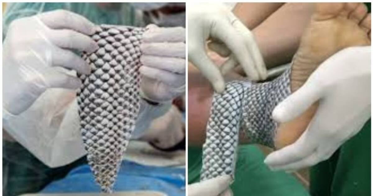 மீன் தோல் வைத்து தீ காயத்திற்கு சிகிச்சை! வியக்க வைக்கும் மருத்துவ முறை