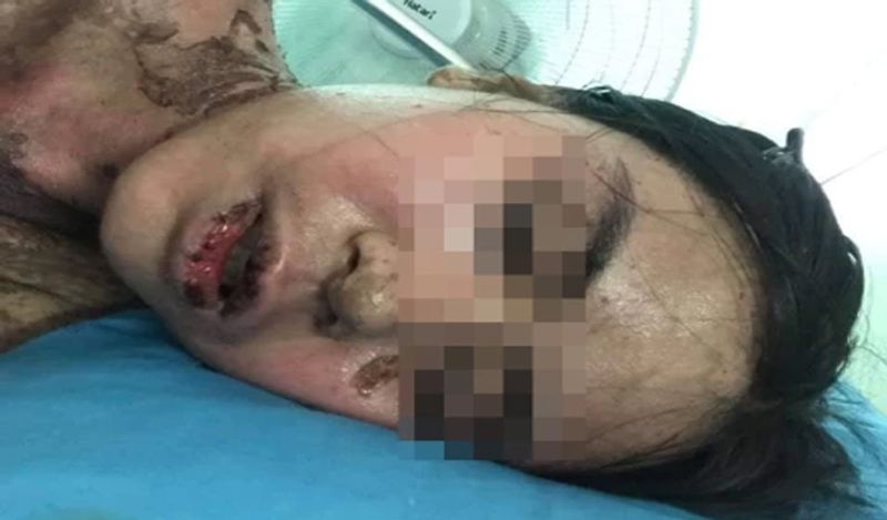 सोशल मीडिया पर थाईलैंड का एक मामला सामने आया। इसमें एक महिला ने दांतों की सर्जरी करवाई। थोड़ा दर्द होने पर वो केमिस्ट से इबुप्रोफेन ले आई। लेकिन इसके बाद उसका पूरा बदन जलने लगा। 