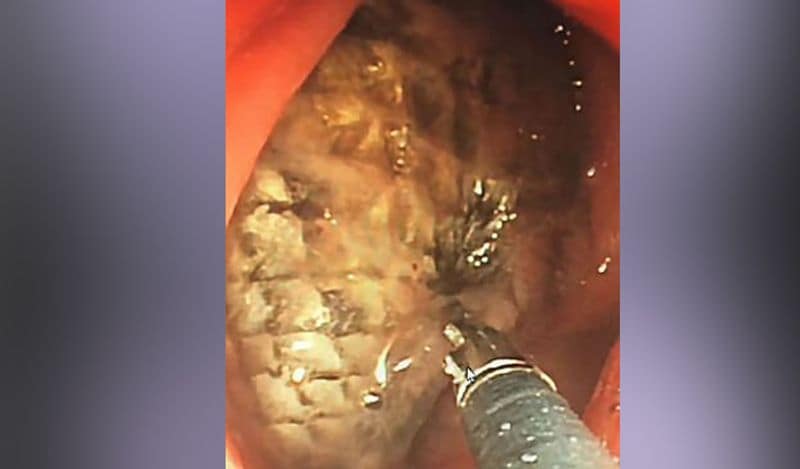 चीन के ग्वांगडोंग में डॉक्टर्स ने शख्स के आंत से 16 इंच की मछली निकाली। उसने मछली को खाया नहीं था। बल्कि ये पीछे से उसके अंदर घुस गया था।

