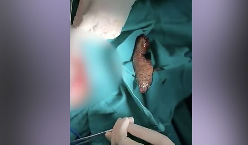  इसके लिए डॉक्टर्स को शख्स का पेट फाड़ना पड़ा। इसके बाद मछली को बाहर निकाला गया। 