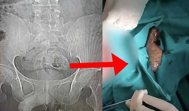चीन में एक 30 साल के शख्स के आंत से डॉक्टर्स ने एक पूरी मछली को बाहर निकाला। शख्स का कहना है कि मछली उसके अंदर तब घुसी जब वो उसके ऊपर बैठ गया था। 