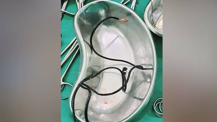Teen In Turkey Admitted With Stomach Pain, Doctors Find Three-Feet-Long Charging Cable Inside Teen In Turkey Admitted With Stomach Pain, Doctors Find Three-Feet-Long Charging Cable Inside