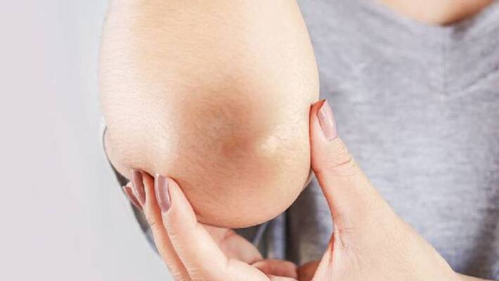 How to get rid of dark elbows and knees naturally How to get rid of dark elbows and knees naturally