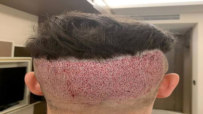 man died after Hair Transplant surgery know procedure risks and precaution NTP man died after Hair Transplant surgery know procedure risks and precaution NTP