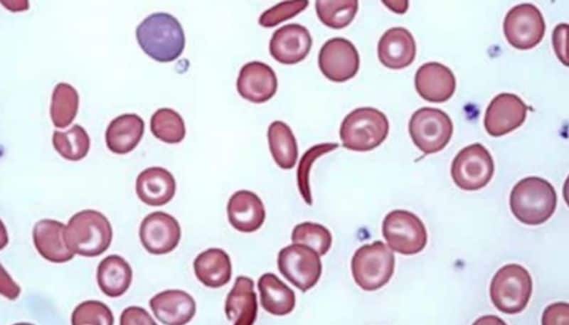 main symptoms of sickle cell anemia