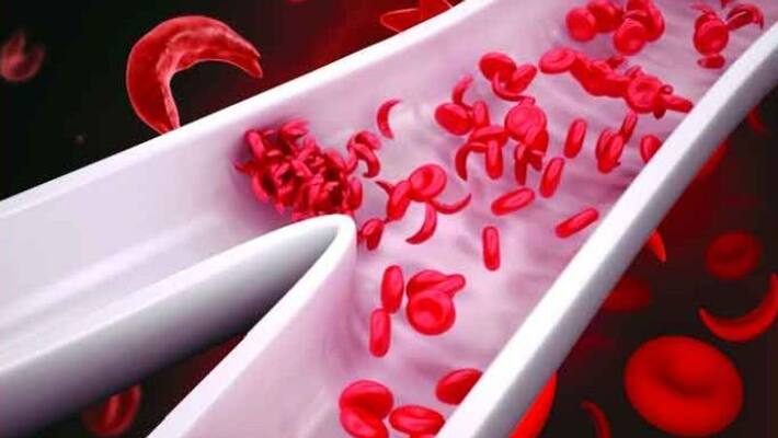 main symptoms of sickle cell anemia main symptoms of sickle cell anemia