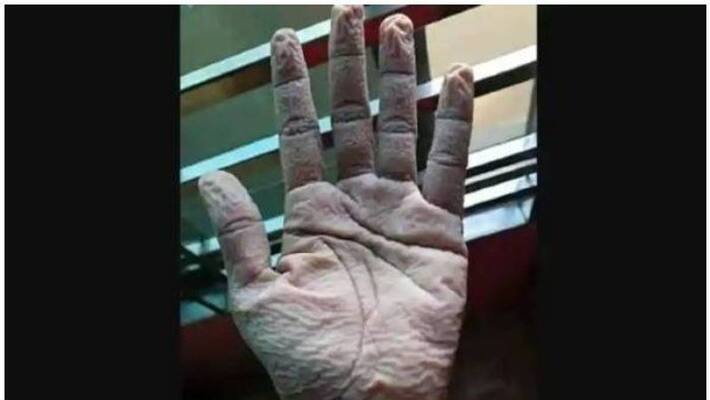 Picture of doctor's wrinkled palm after wearing gloves for 10 hours Picture of doctor's wrinkled palm after wearing gloves for 10 hours