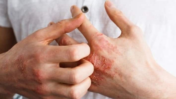 gut health may cause skin diseases says experts gut health may cause skin diseases says experts