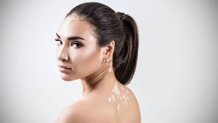 today is World Vitiligo Day today is World Vitiligo Day