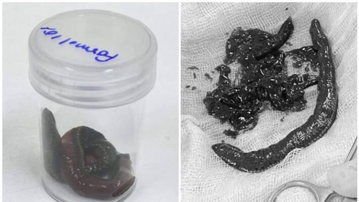 Leech swims up man's penis drinks pint of blood before docs pull it out Leech swims up man's penis drinks pint of blood before docs pull it out