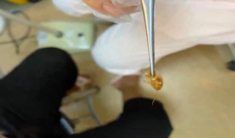 shocking footage of cockroach crawling inside mans ears kph