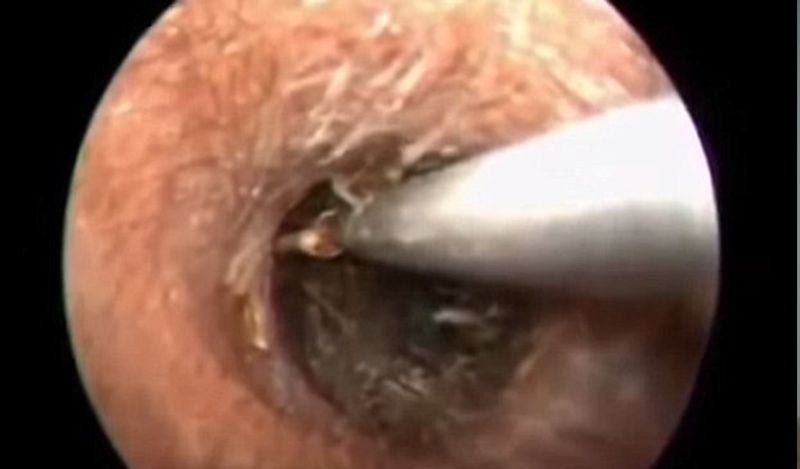 shocking footage of cockroach crawling inside mans ears kph