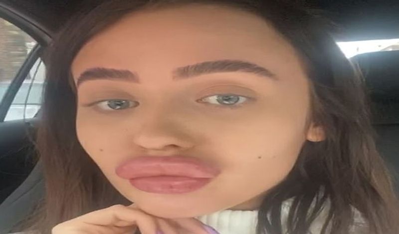 21 year old flight attendant lips surgery fail made her look like pig kph