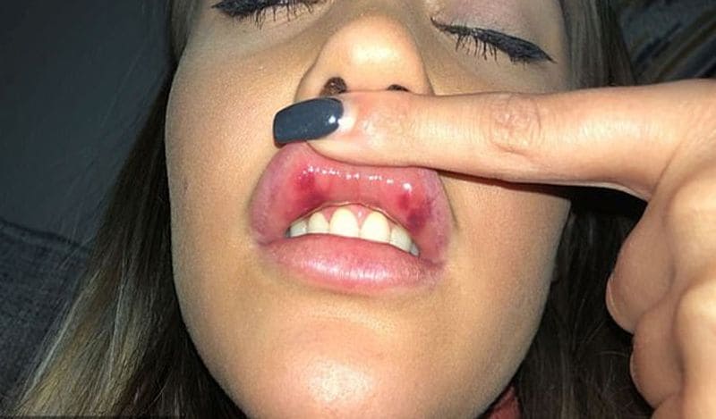 21 year old flight attendant lips surgery fail made her look like pig kph