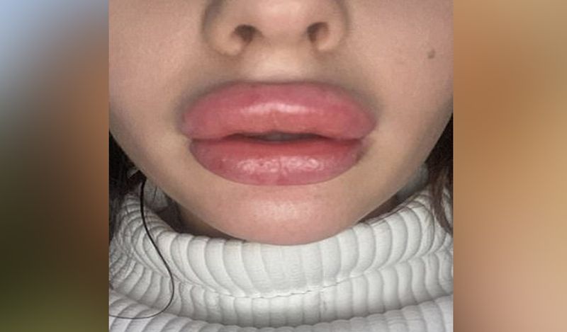21 year old flight attendant lips surgery fail made her look like pig kph