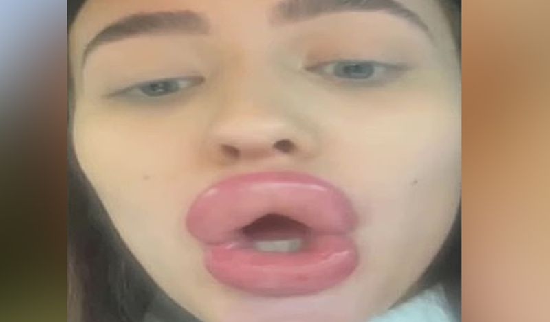 21 year old flight attendant lips surgery fail made her look like pig kph