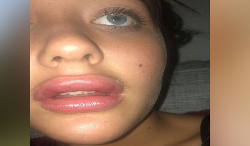 21 year old flight attendant lips surgery fail made her look like pig kph