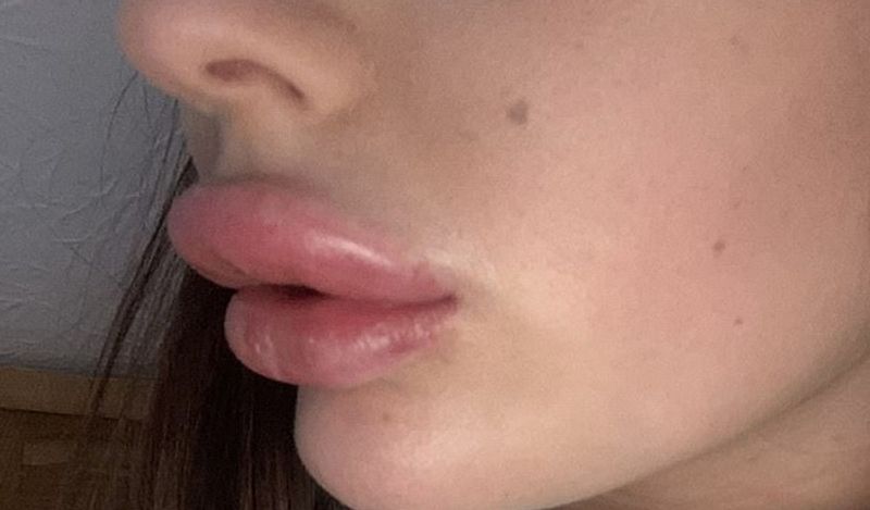 21 year old flight attendant lips surgery fail made her look like pig kph