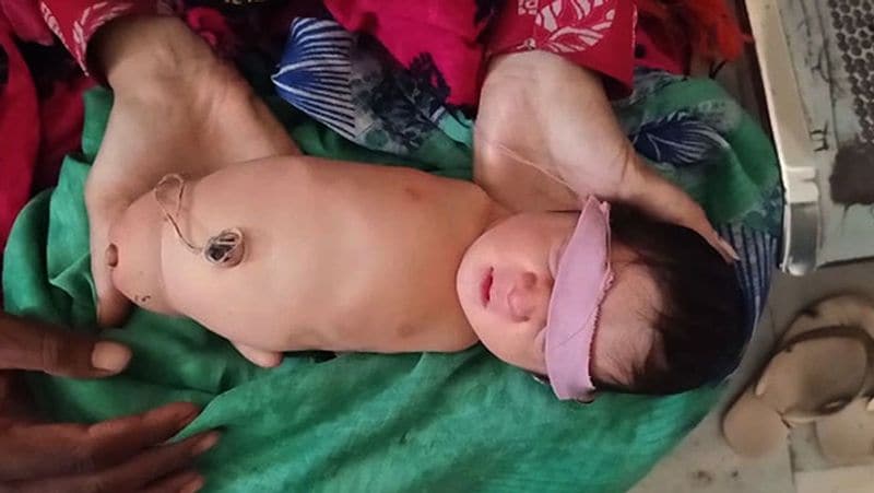 baby girl born with out arms and legs and people are assuming the miracle of god in MadhyaPradesh