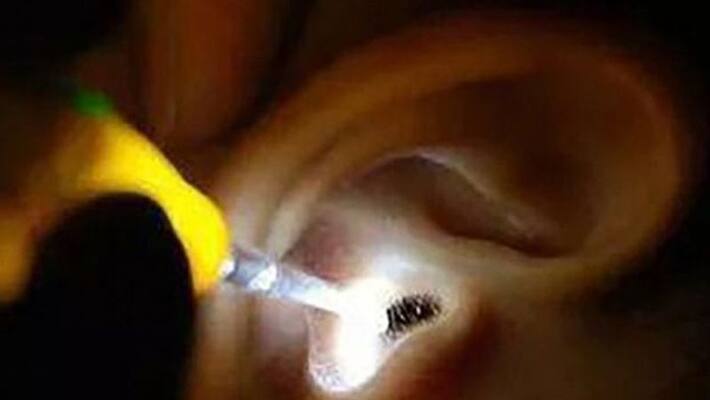 Doctor pulls live cockroach from Chinese womans ear Doctor pulls live cockroach from Chinese womans ear