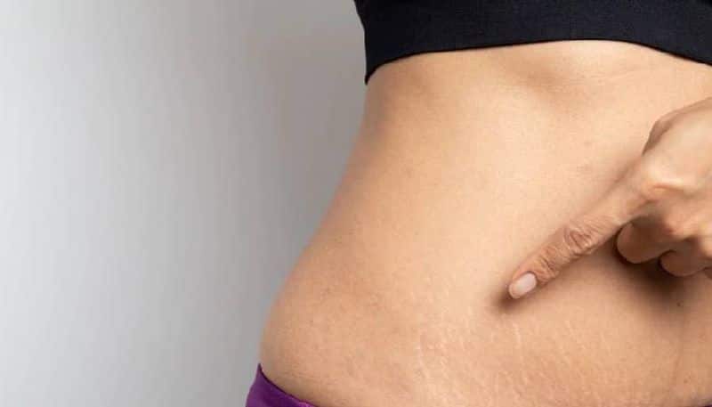Castor oil can heal your stretch marks