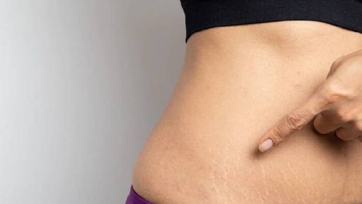 how to get rid of stretch marks how to get rid of stretch marks