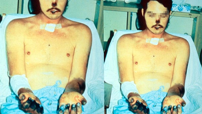 What is bubonic plague Symptoms causes and precautions you must know BSS