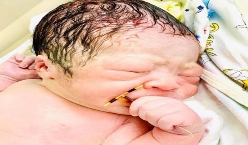 baby boy born holding mothers contraceptive coil from womb which was stopping her getting pregnant kph