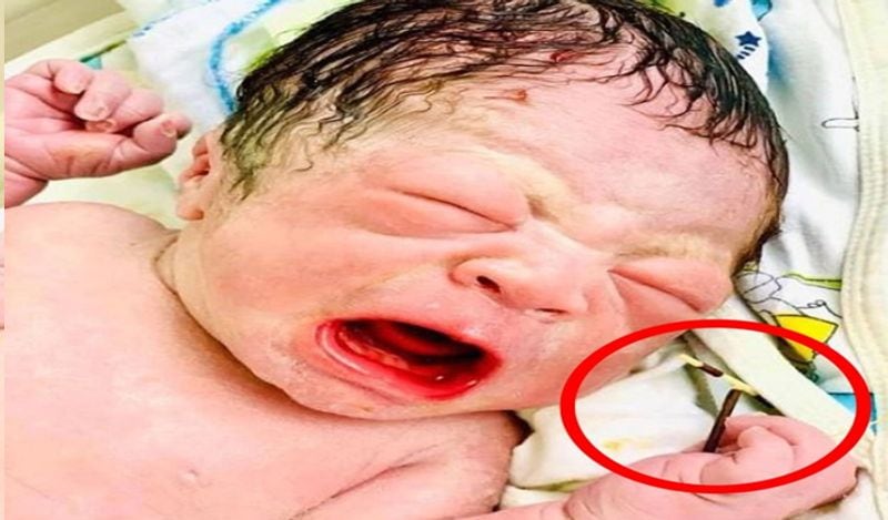 baby boy born holding mothers contraceptive coil from womb which was stopping her getting pregnant kph