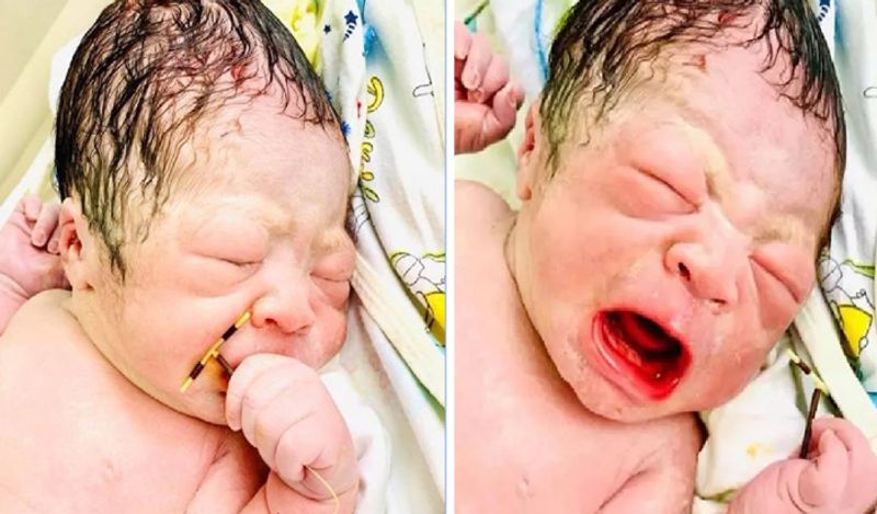 baby boy born holding mothers contraceptive coil from womb which was stopping her getting pregnant kph