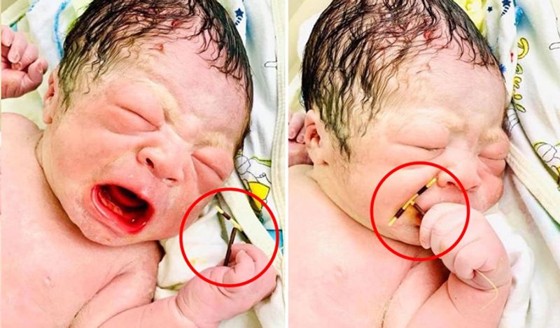 baby boy born holding mothers contraceptive coil from womb which was stopping her getting pregnant kph