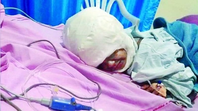 10 year old girl trapped in the hair generator skin separated from head and ears admitted kpr