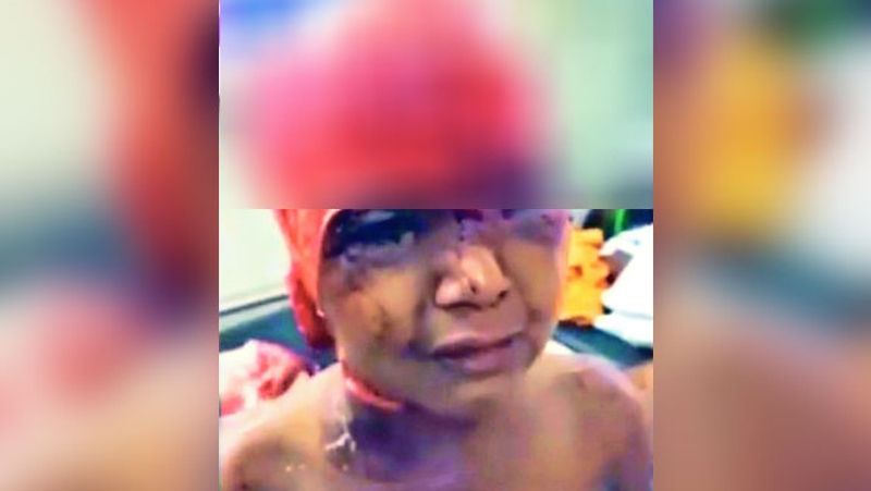 10 year old girl trapped in the hair generator skin separated from head and ears admitted kpr
