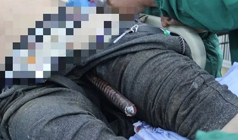 shocking 3 foot iron rod passed through private part of the contractor doctors kept pulling for 3 hours kph