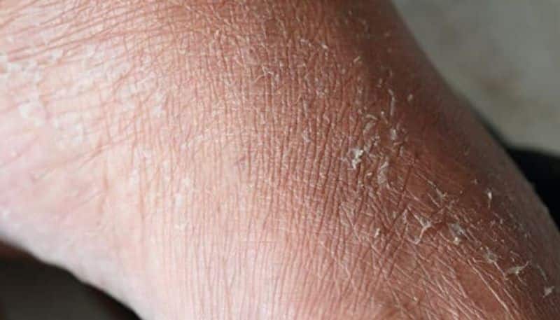 symptoms of dehydration can be seen on skin