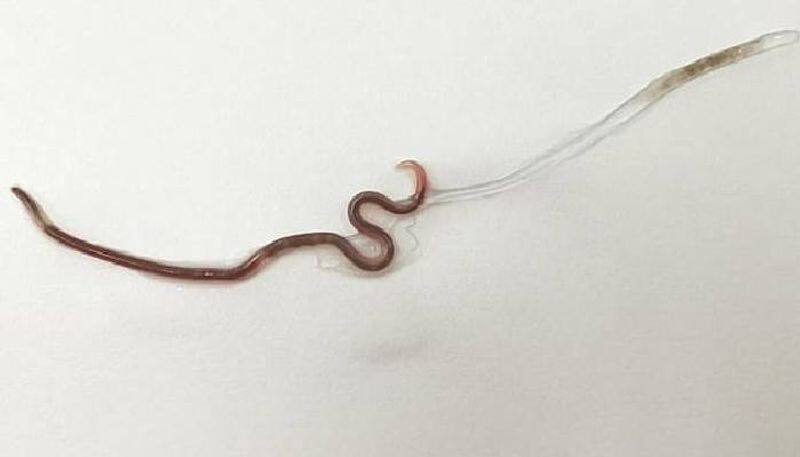 doctors pull  live worm from women s tonsils