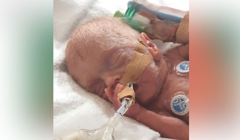 miracle baby girl born in just 24 weeks weighing 450 grams survival story kph