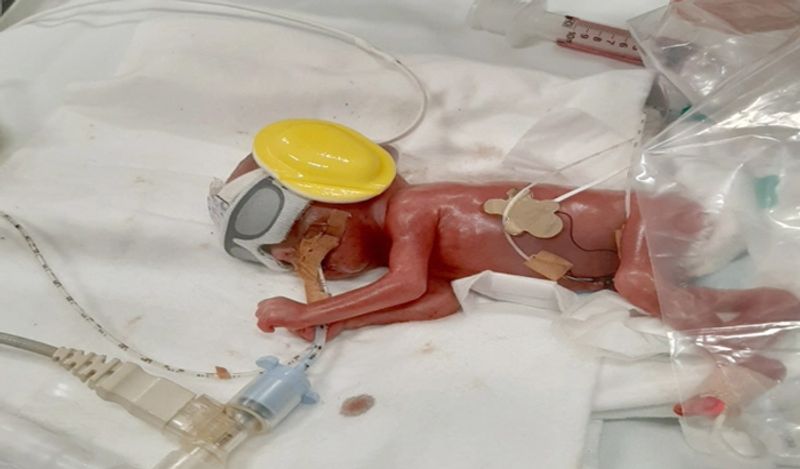 miracle baby girl born in just 24 weeks weighing 450 grams survival story kph