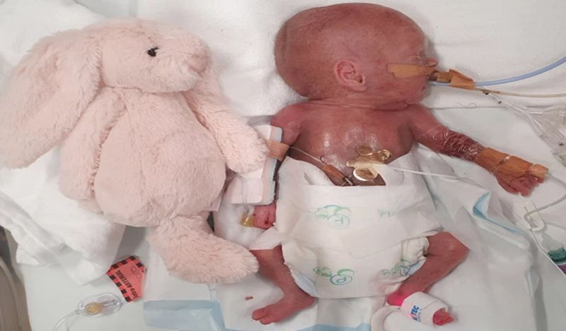 miracle baby girl born in just 24 weeks weighing 450 grams survival story kph