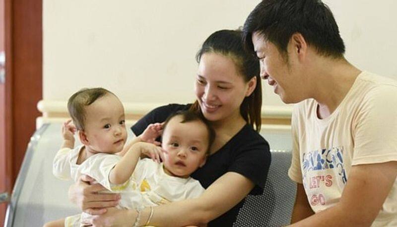 doctors successfully separate conjoined 13 month old twin girls