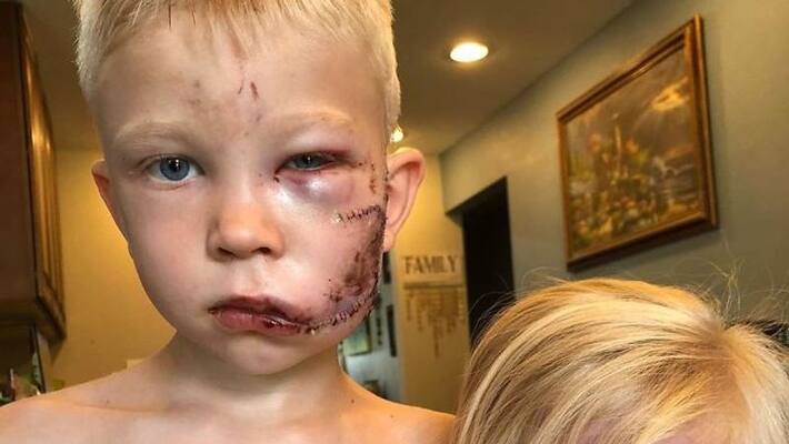 6-Year-Old Superhero Brother Saves Sister From Dog Attack, Gets 90 Stitches And Praise From The Avengers 6-Year-Old Superhero Brother Saves Sister From Dog Attack, Gets 90 Stitches And Praise From The Avengers