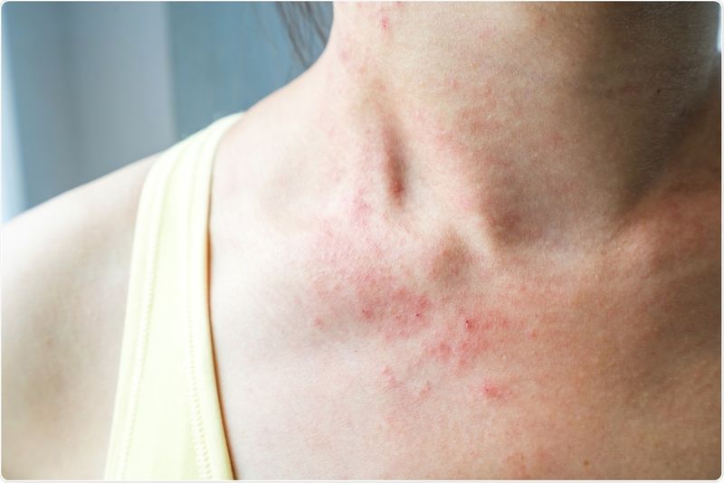 Most covid positive patients have one of these symptoms