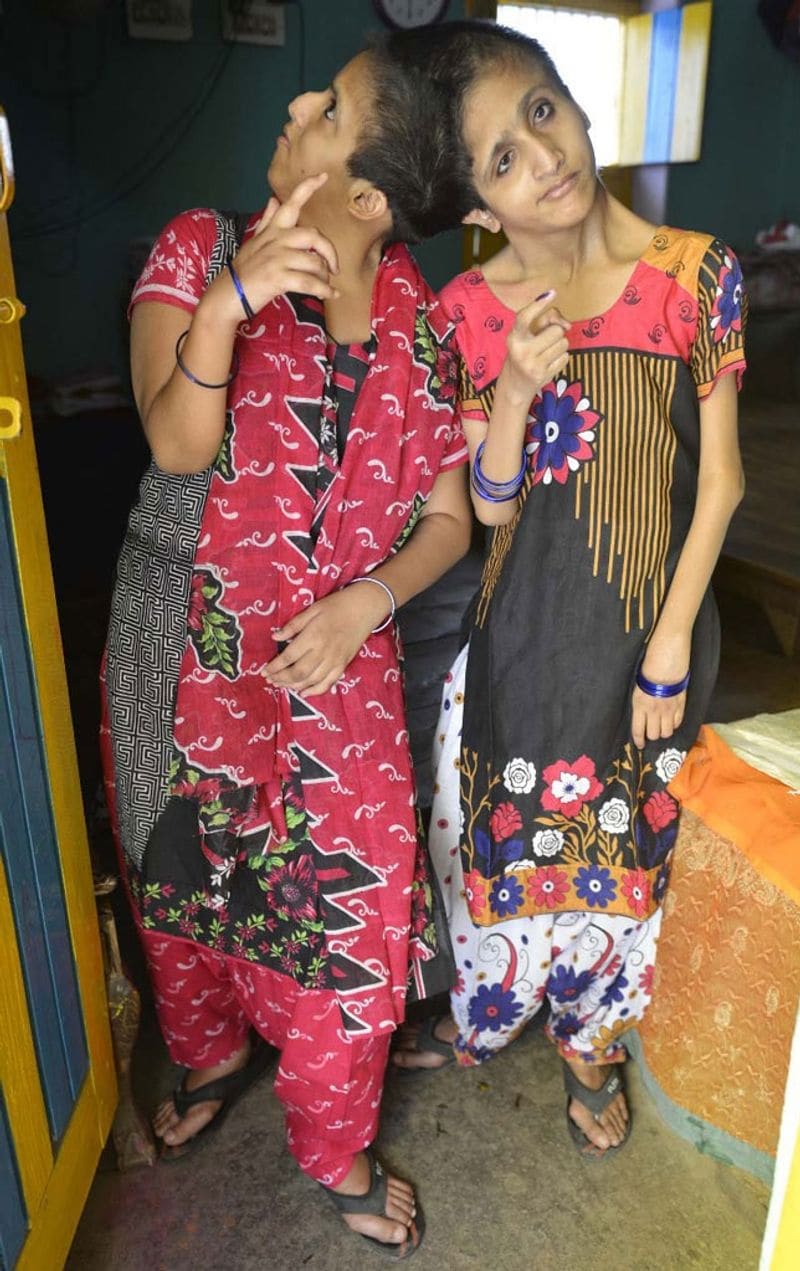 बताते चले कि सबा-फरहा का जीवन संघर्ष भरा रहा है। सिर से जुड़ी होने के कारण हर वक्त साथ रहतीं हैं। कुछ बड़ी हुईं तो दोनों को सर्जरी के माध्यम से अलग करने की पहल शुरू हुई, लेकिन बात नहीं बनी। 