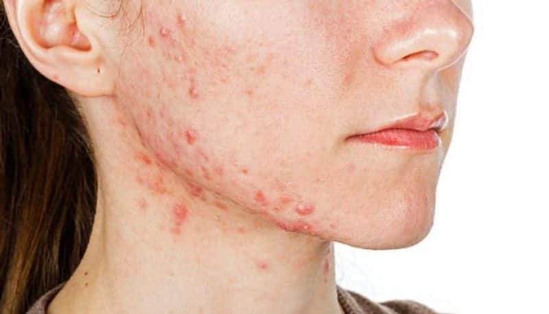 find out the reasons behind acne and here are some tips to hack this