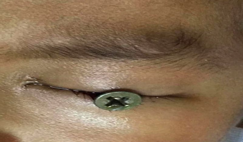 Out Of Fathers Negligence Iron Nail pierced in 3 year old boys eye ball in thailand