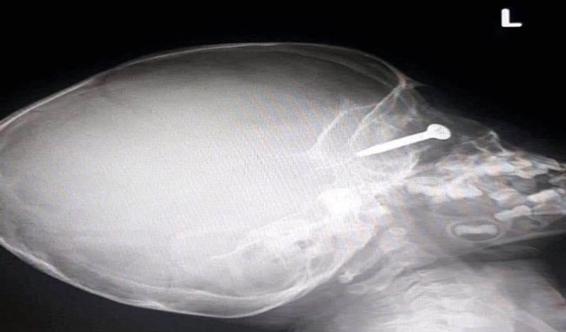 Out Of Fathers Negligence Iron Nail pierced in 3 year old boys eye ball in thailand