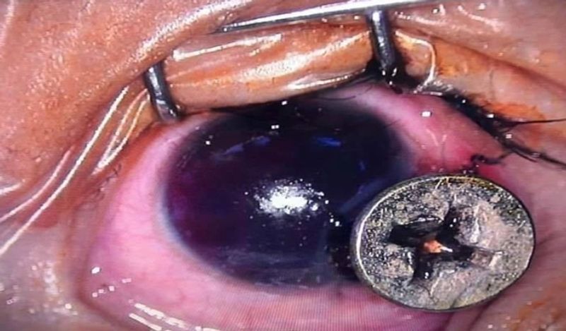 Out Of Fathers Negligence Iron Nail pierced in 3 year old boys eye ball in thailand