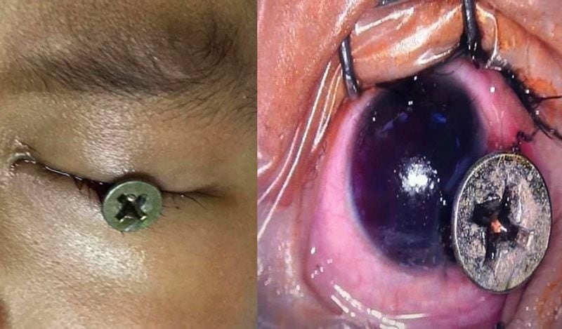 Out Of Fathers Negligence Iron Nail pierced in 3 year old boys eye ball in thailand